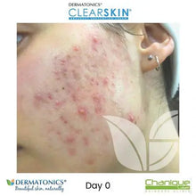 Load image into Gallery viewer, Dermatonics Clearskin® 50ml