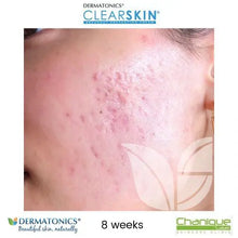 Load image into Gallery viewer, Dermatonics Clearskin® 50ml